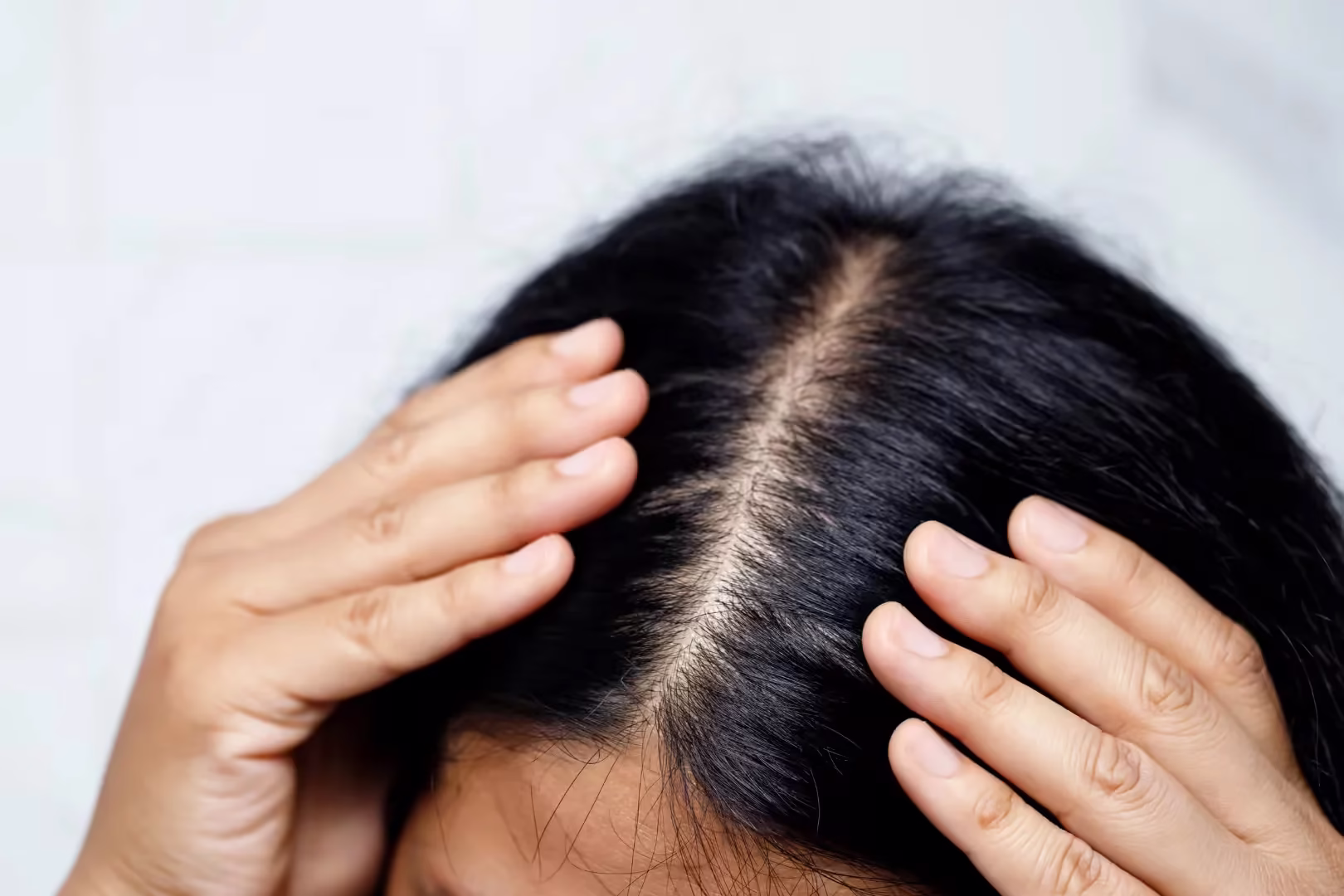 Antifungal Treatments for Scalp at Madhuram Ozone